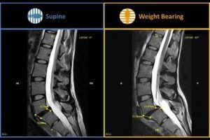 Anterolisthesis Facet Joint Instability