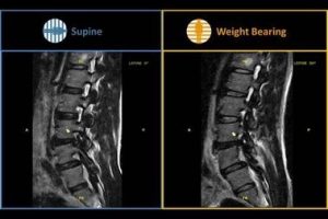 csm_gScanBrio_DiscBulge_1dd3c57091-379x283