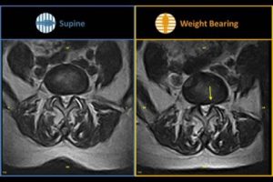 csm_gScanBrio_FacetJointInstability_10_103a7c9331-480x360