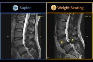 csm_gScanBrio_Spondylolisthesis_10_b6feb3db01-480x360