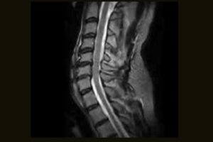 C-Spine FSE T2 Sagittal