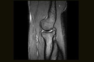 Elbow GE T2 Sagittal