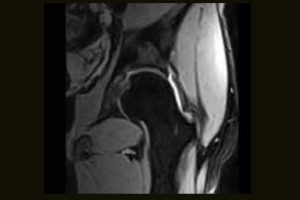 Hip XBONE T2 Coronal