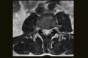 L-Spine 3D-HYCE Axial