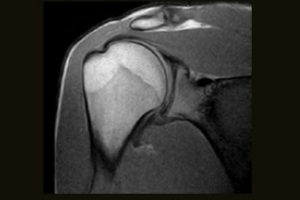 Shoulder SE T1 Coronal